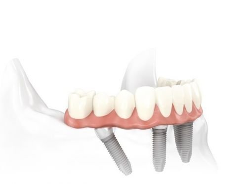 Specialist Oral Surgery - Dentists Australia