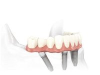 Specialist Oral Surgery - Dentist in Melbourne