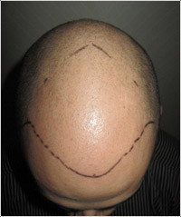 Hair Transplant Abroad - thumb 5